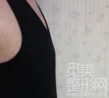 乳房下垂矫正+水滴形假体隆胸术后４个月后