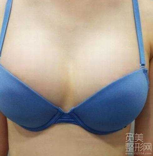 切除副乳+水滴形假体隆胸手术5个月后记