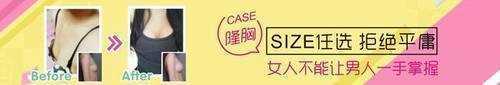 上海九院做假体隆胸整形1年后案例图怎么样