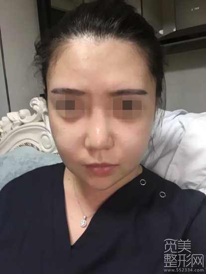 颧骨整形 下颌角整形 隆鼻修复 自体脂肪填充 嘴