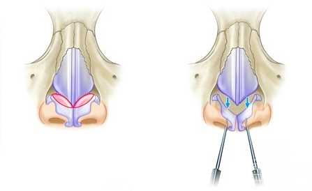 鼻中隔延长鼻尖手术介绍
