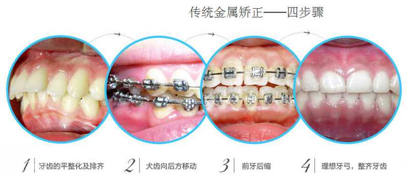 常见畸形牙:龅牙,虎牙,地包天,天包地,个小牙,牙列不齐,牙列稀疏,牙齿