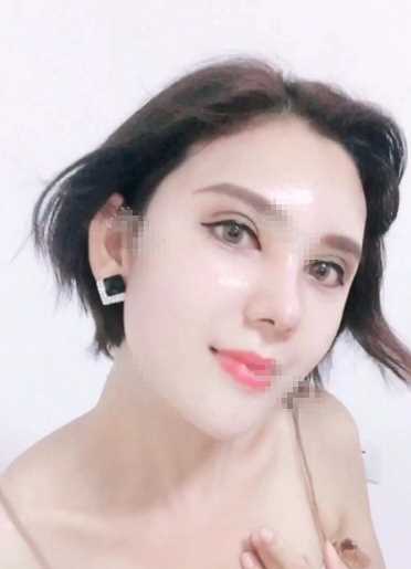 鼻翼缩小术后30天的*果图