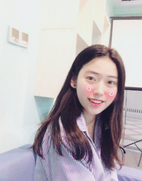 【面部吸脂术后第35天】一起变美啦(*^__^*) 嘻嘻…