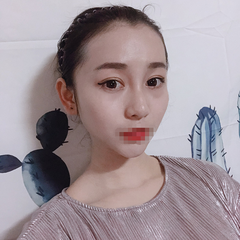 *术后97天了 鼻子和眼睛还是那么美美哒