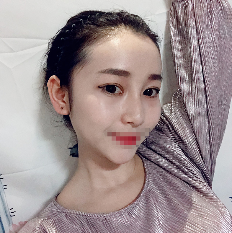 *术后97天了 鼻子和眼睛还是那么美美哒