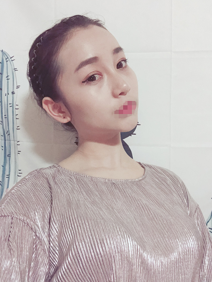 *术后97天了 鼻子和眼睛还是那么美美哒