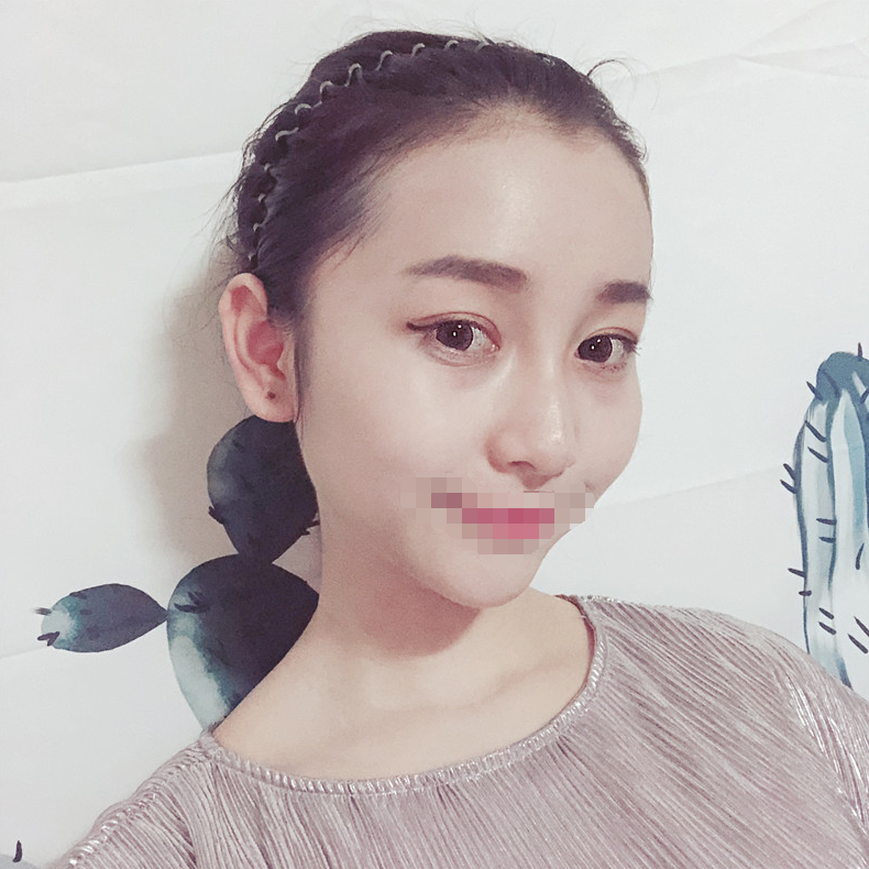 *术后97天了 鼻子和眼睛还是那么美美哒