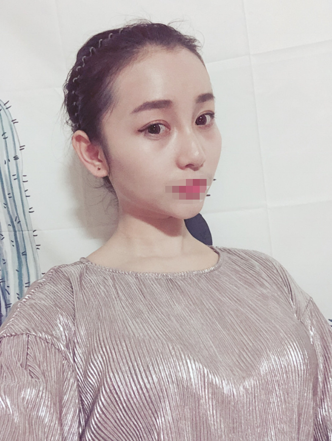 *术后97天了 鼻子和眼睛还是那么美美哒