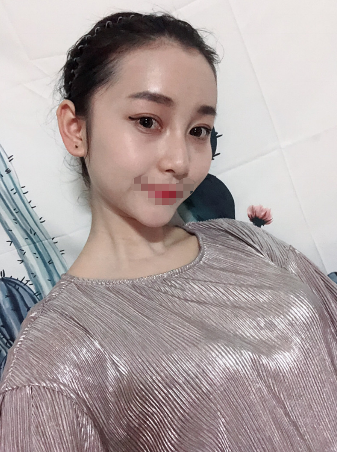 *术后97天了 鼻子和眼睛还是那么美美哒