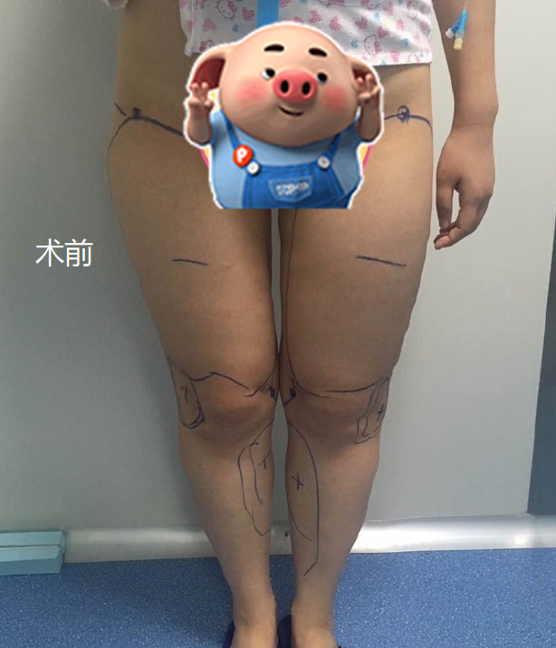 【大腿吸脂投稿分享】 南京吸脂华美 康美的王健怎么样？