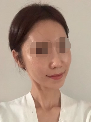 术后已经一年多了 基本上恢复得很满意 上海华美李志海磨骨案例图分享