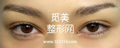 韩式三点式好吗？简单概括一下韩式三点双眼皮的优势！
