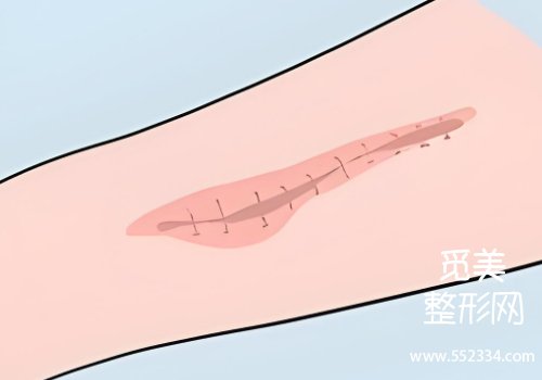 成都疤痕修复吕靖医生好吗？详细剖析了医生资料